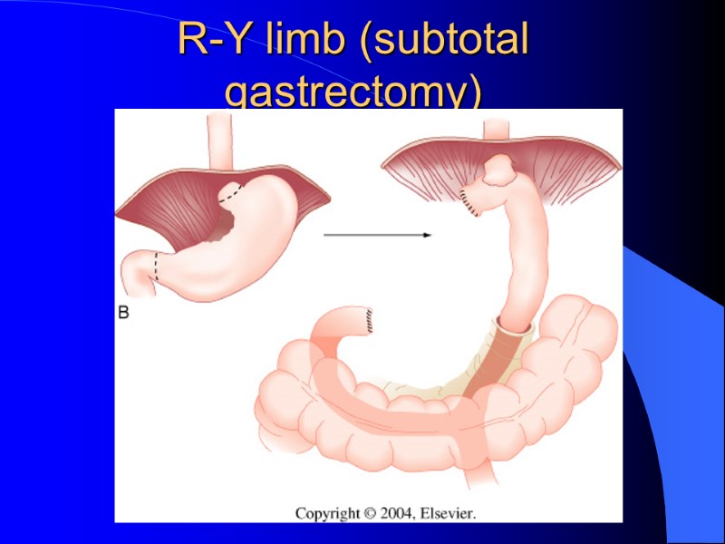 R-Y limb (subtotal gastrectomy)